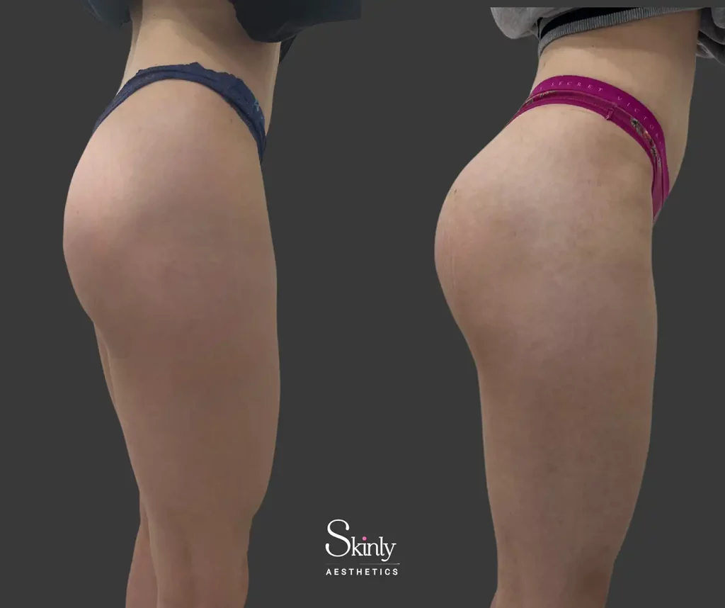 NYC Liquid Butt Lift with HA and PLLA fillers side view