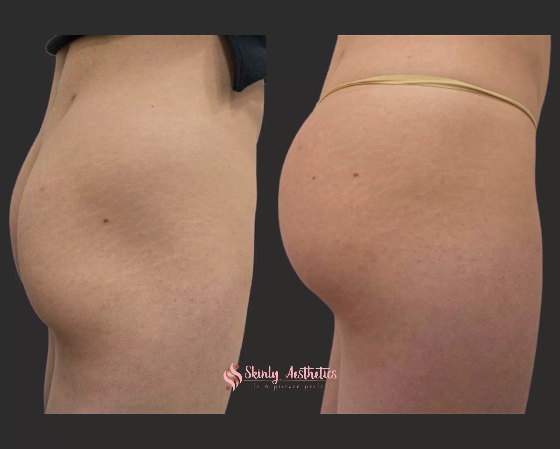 sculptra butt lift treatment