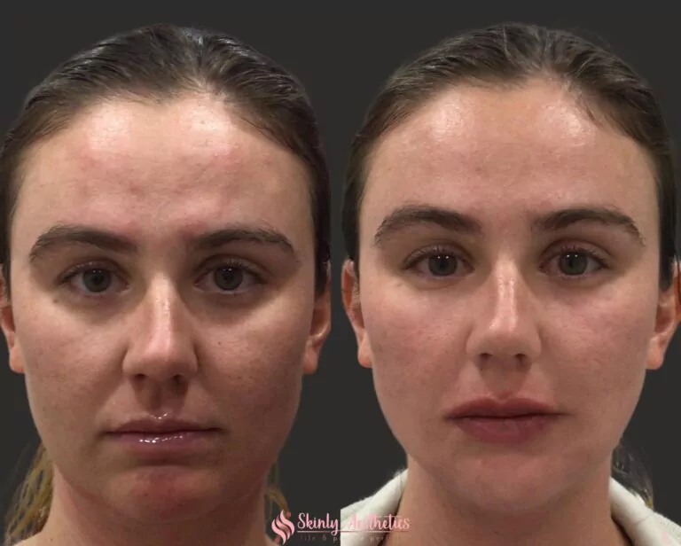 juvederm ultra lip filler enhancement