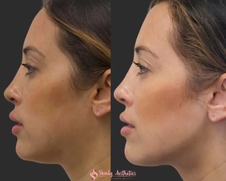 jawline contouring with botox and Juvederm dermal fillers