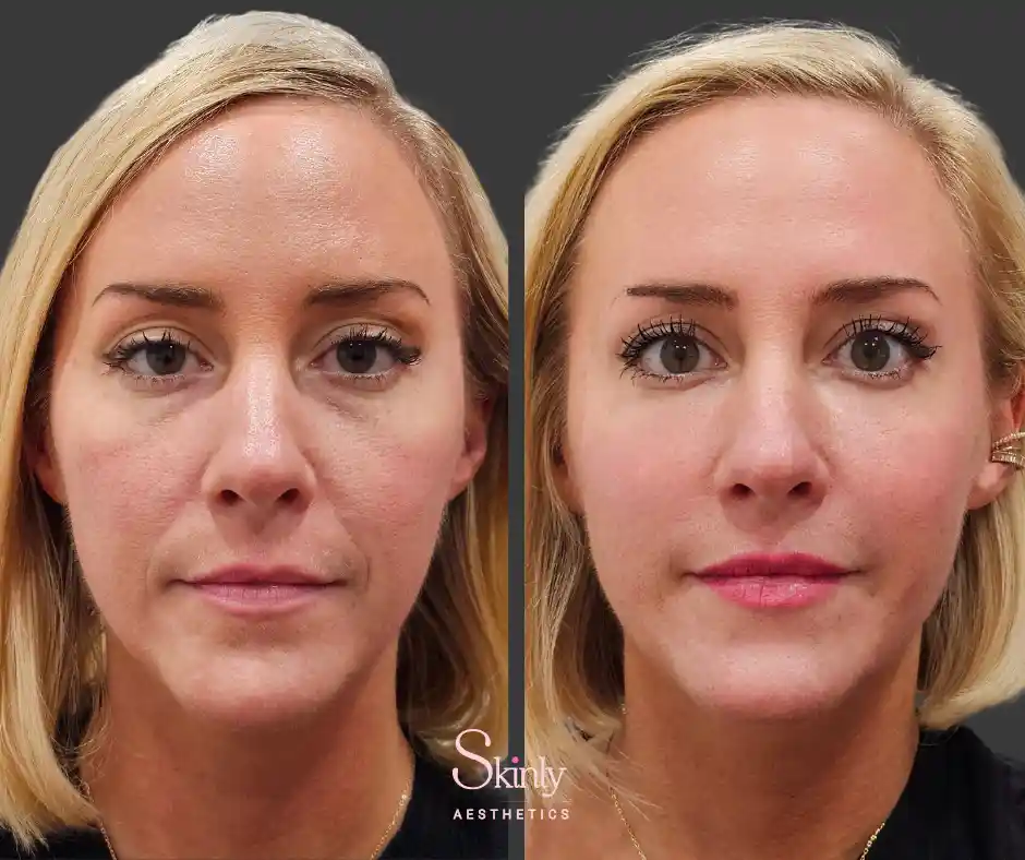 Before and after liquid facelift results performed by Dr. Schwarzburg in NYC