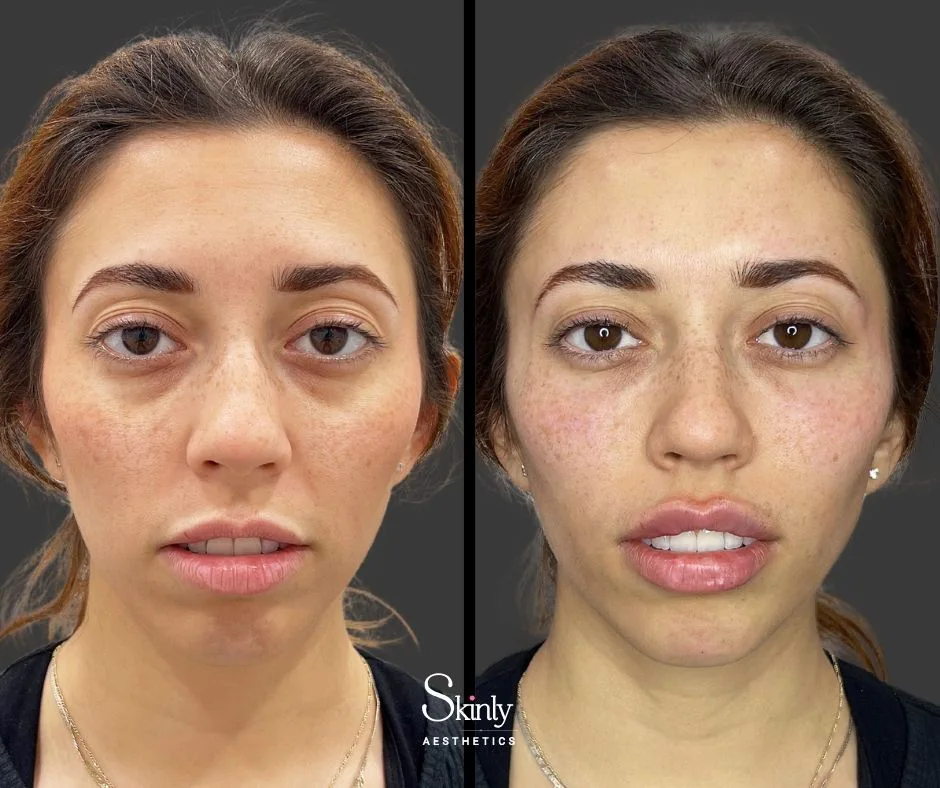 Before and after under eye injections, showing reduced hollowness.