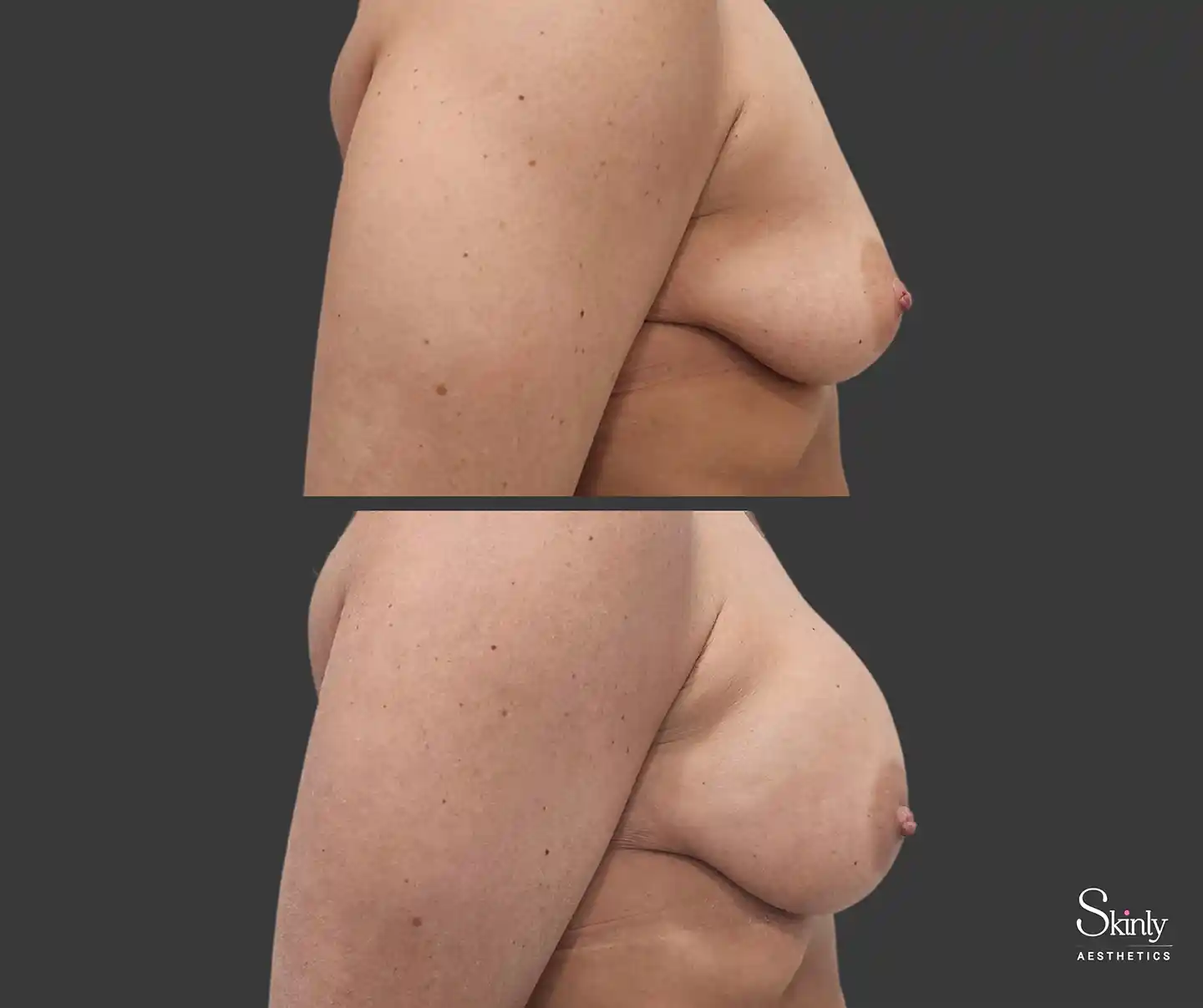 Side perspective of natural results from breast lift with fillers in NYC