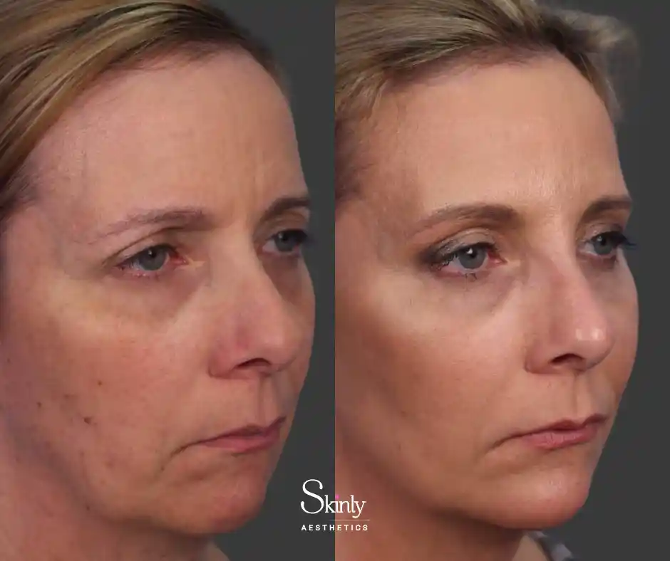 CO2 laser skin tightening results NYC