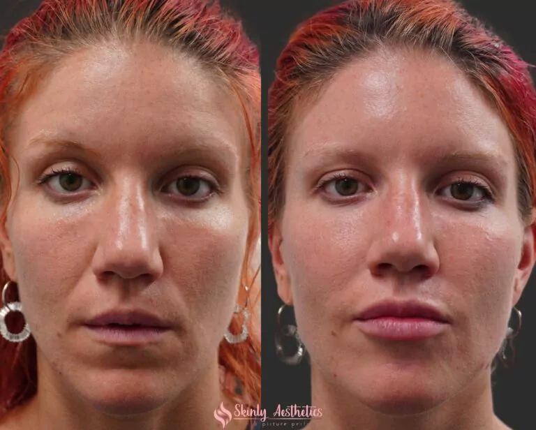 nasolabial fold smoothing Restylane filler