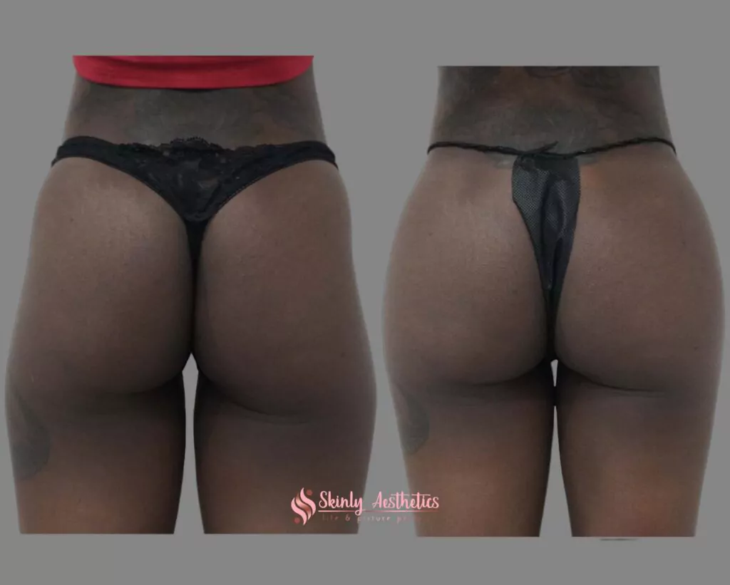 sculptra injections butt lift augmentation