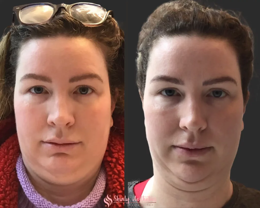 Front view before and after Kybella treatment showcasing noticeable double chin reduction and facial contour improvement by Dr. Schwarzburg.