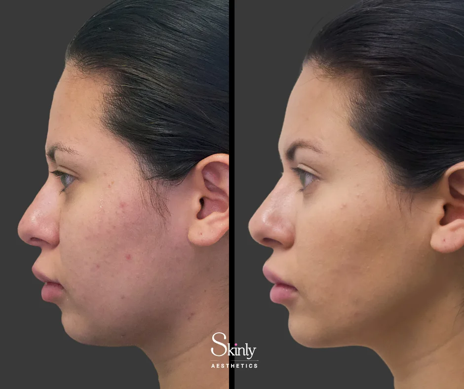 Before and after nose filler, showing straightened bridge.