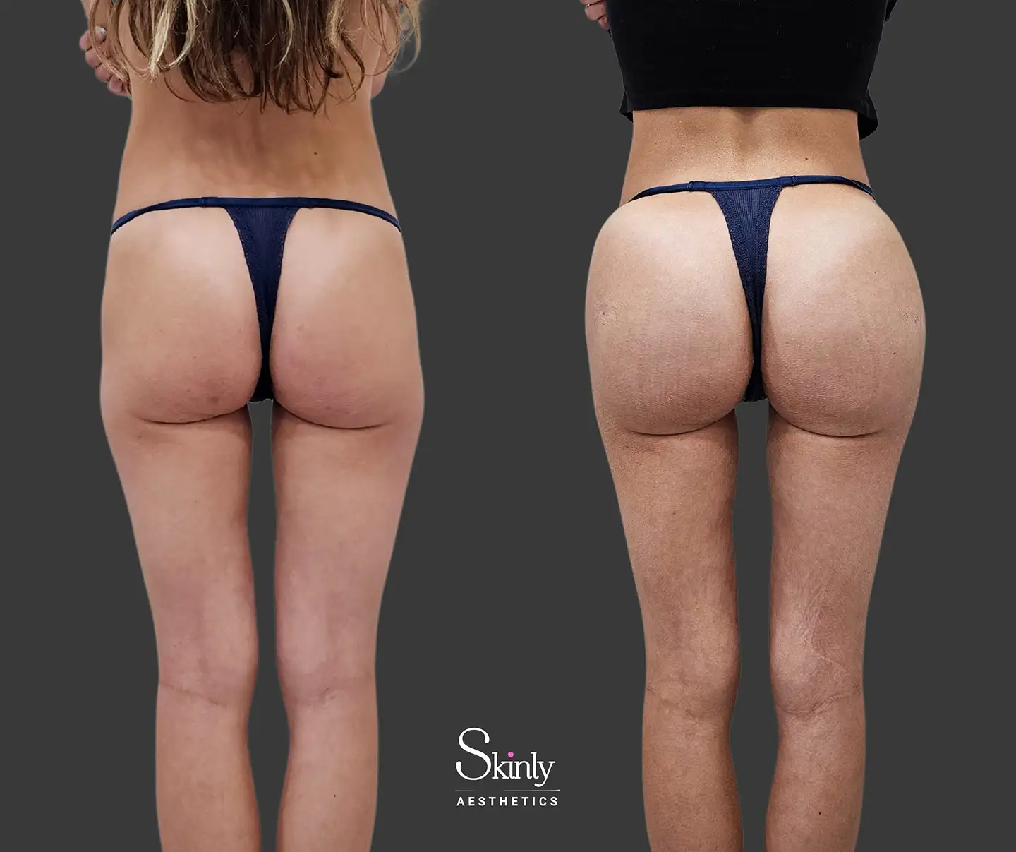 Hyaluronic acid and PLLA filler results from rear side view