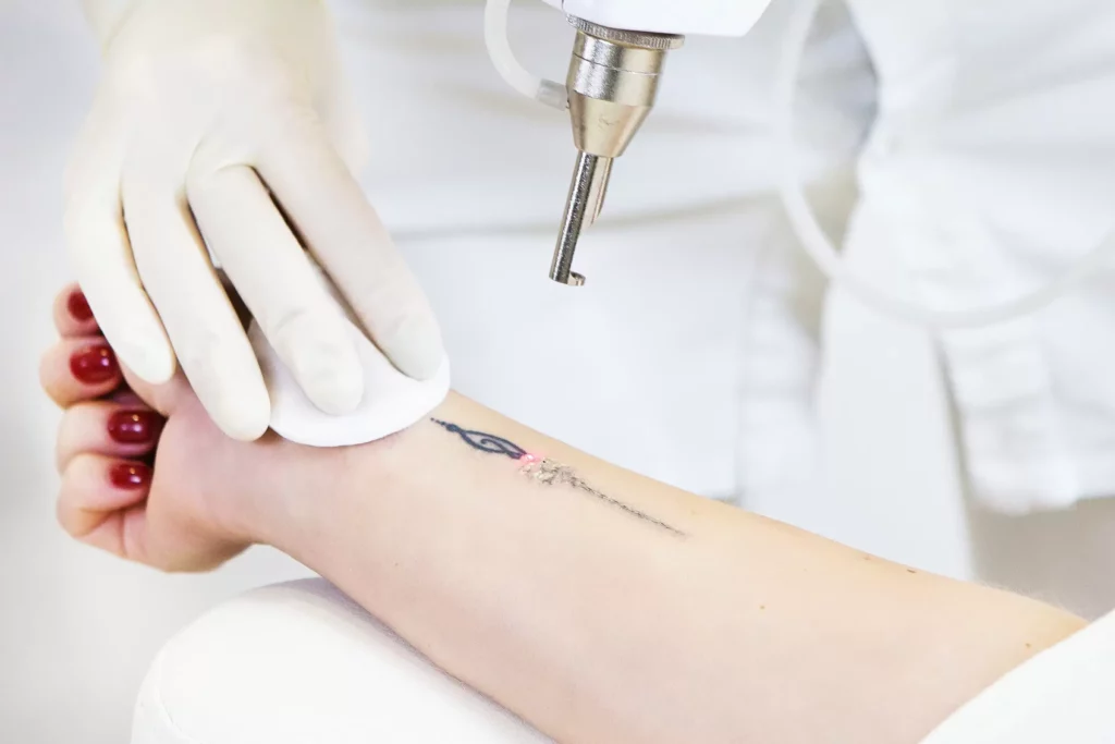 laser tattoo removal
