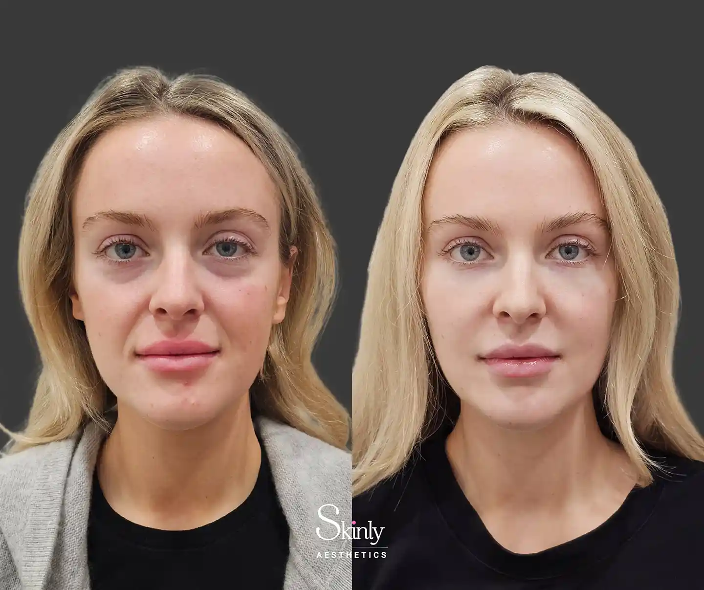 Liquid Facelift before-after showing corrected facial sagging and completely rejuvenated and refreshed look