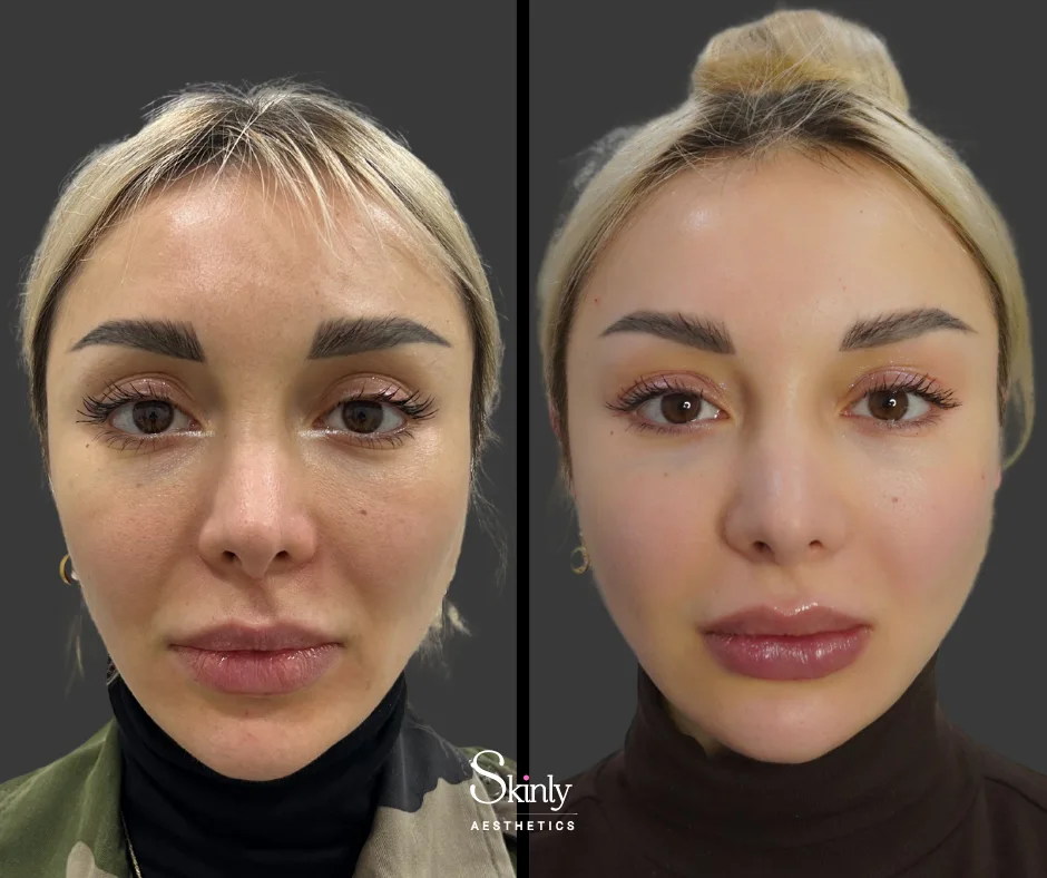 Before and after Russian lip filler, showing enhanced lip volume.