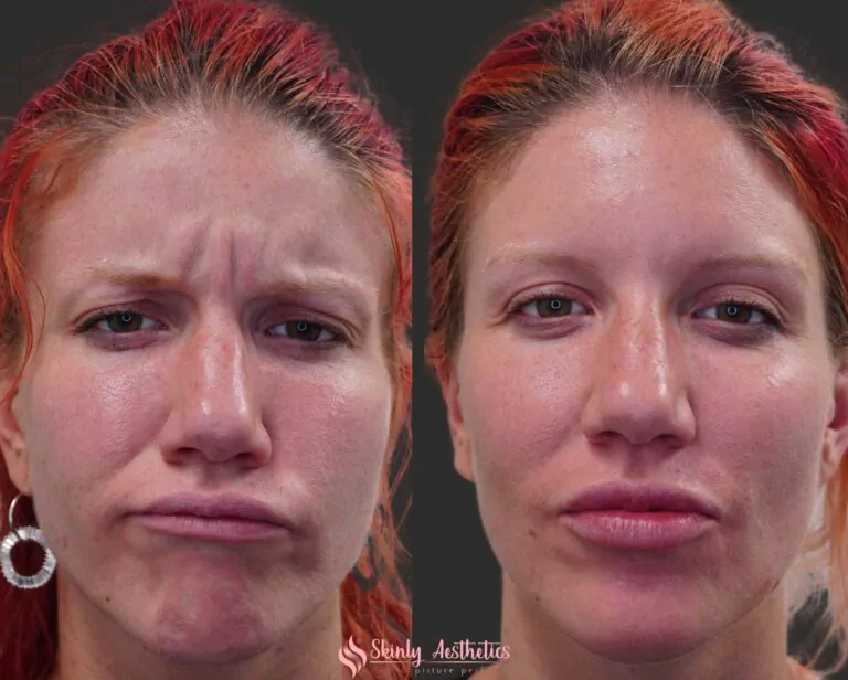 botox 11s lines