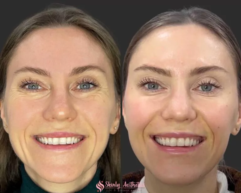 crows feet reduction with 20 units of Botox