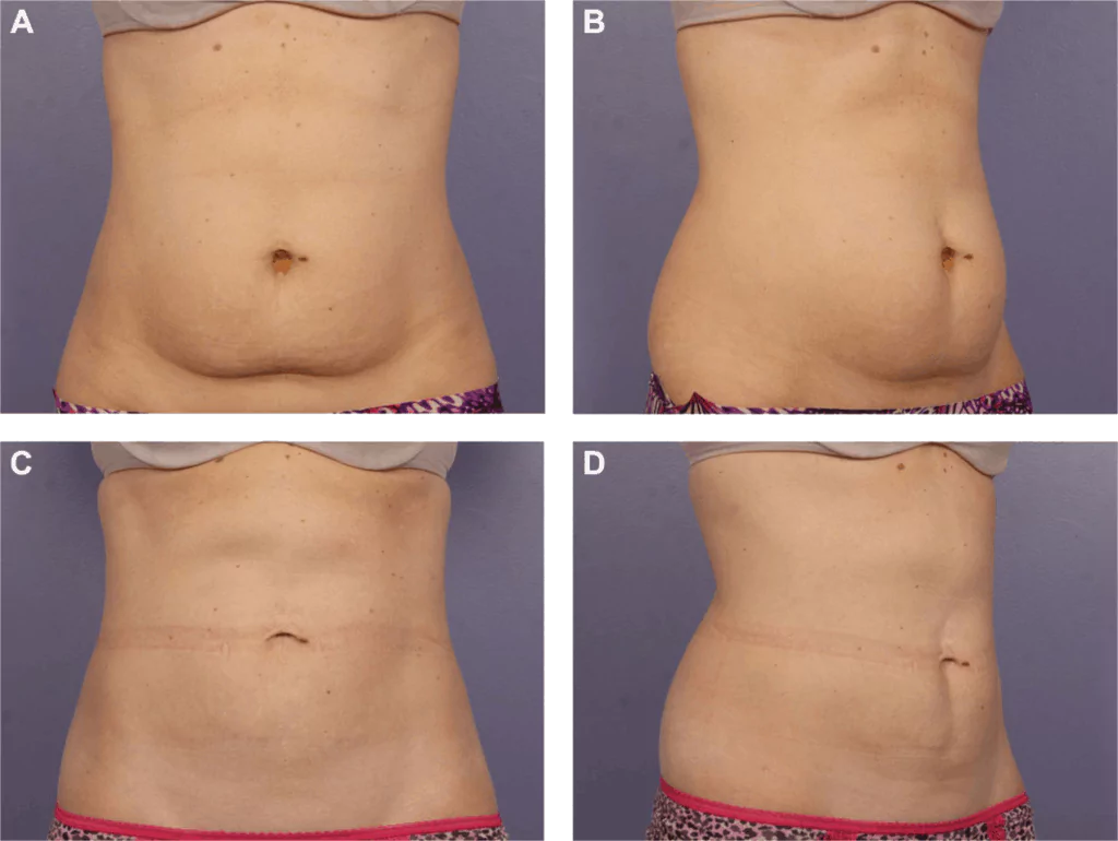 CoolSculpting treatment New York