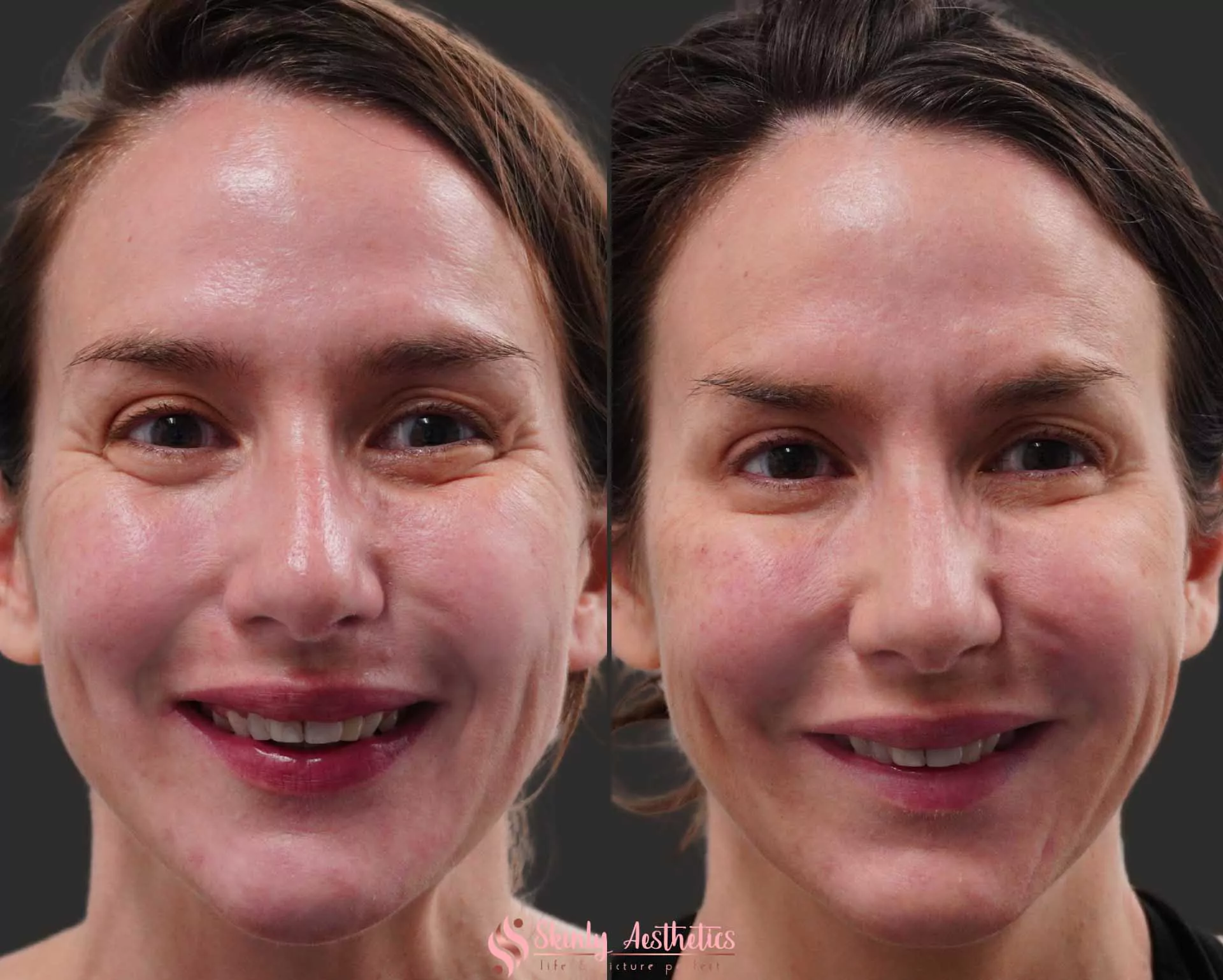 Botox treatment for crows feet