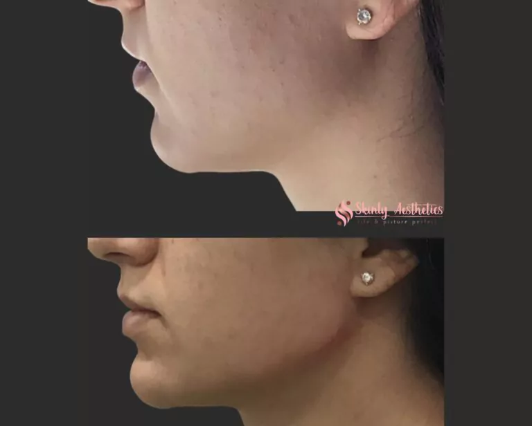jawline sculpting with dermal fillers