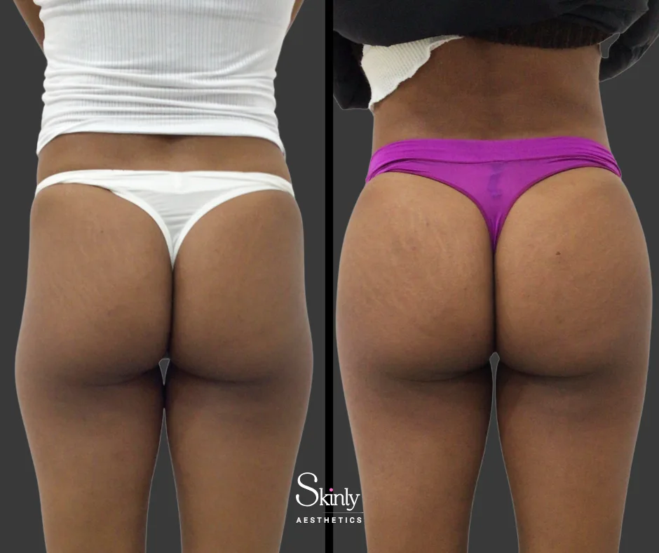 Before and after liquid butt left for hip dips for more symmetrical hips.