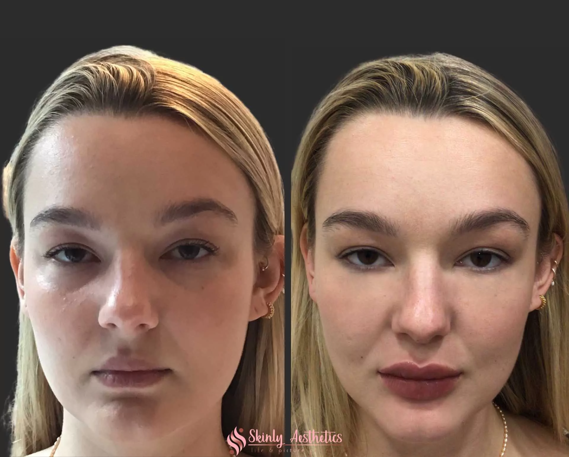 under eye circles injection Juvederm filler