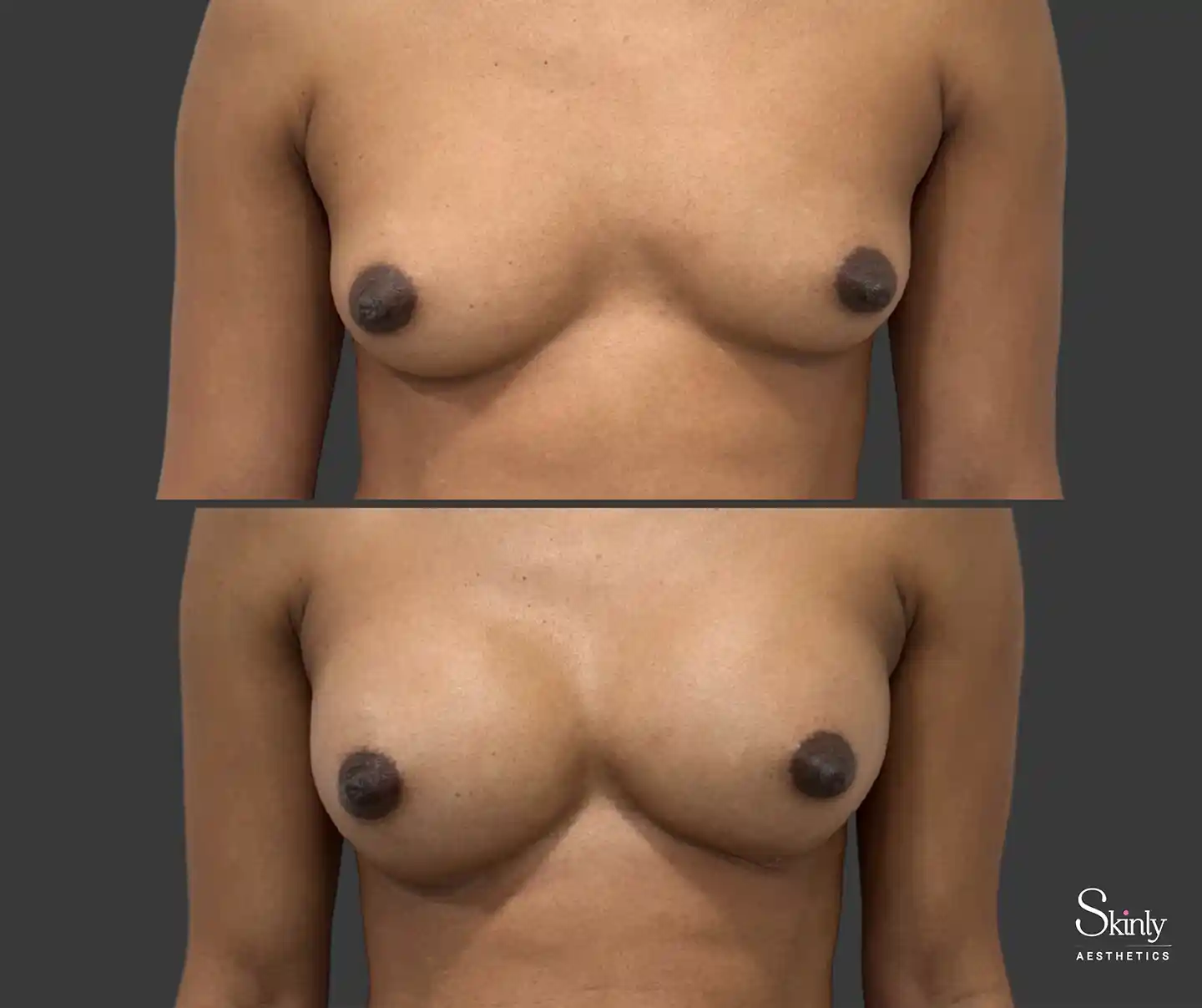 Front breast filler results demonstrating volume restoration