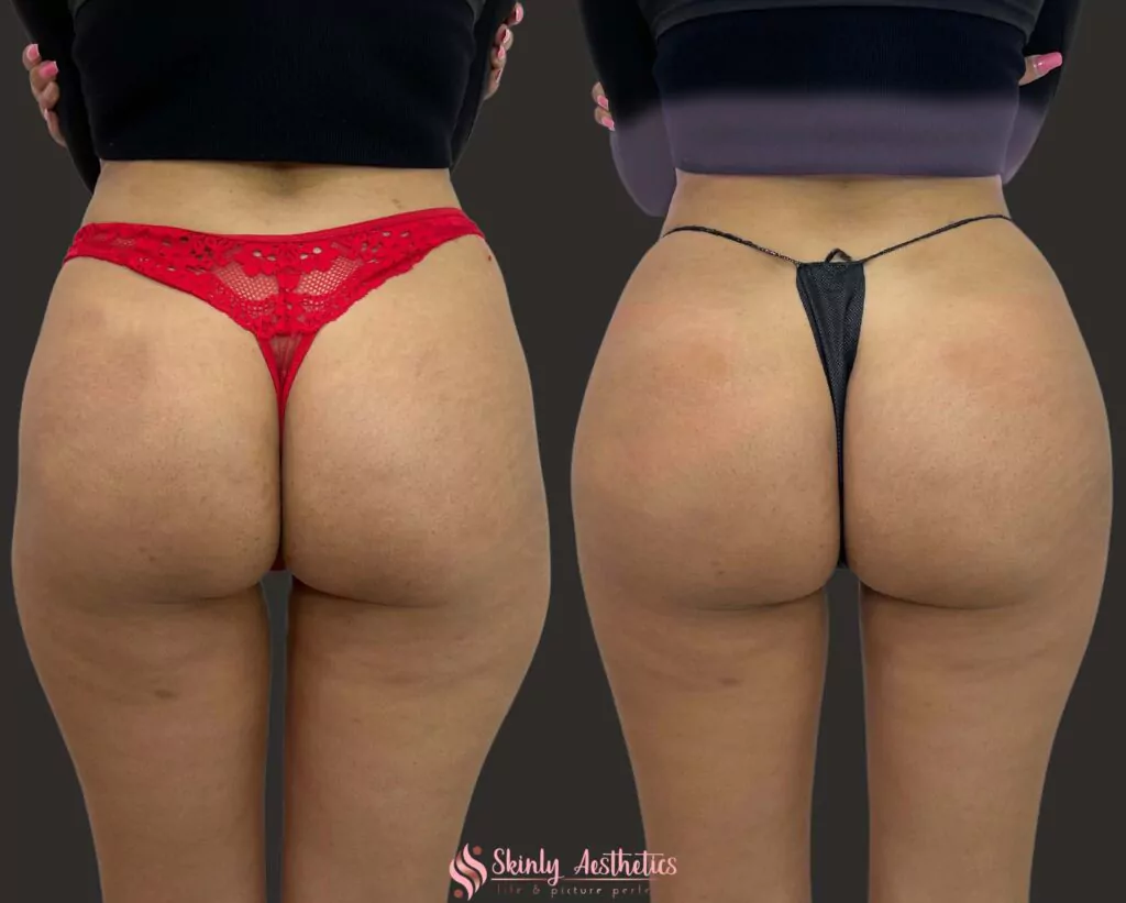 sculptra butt