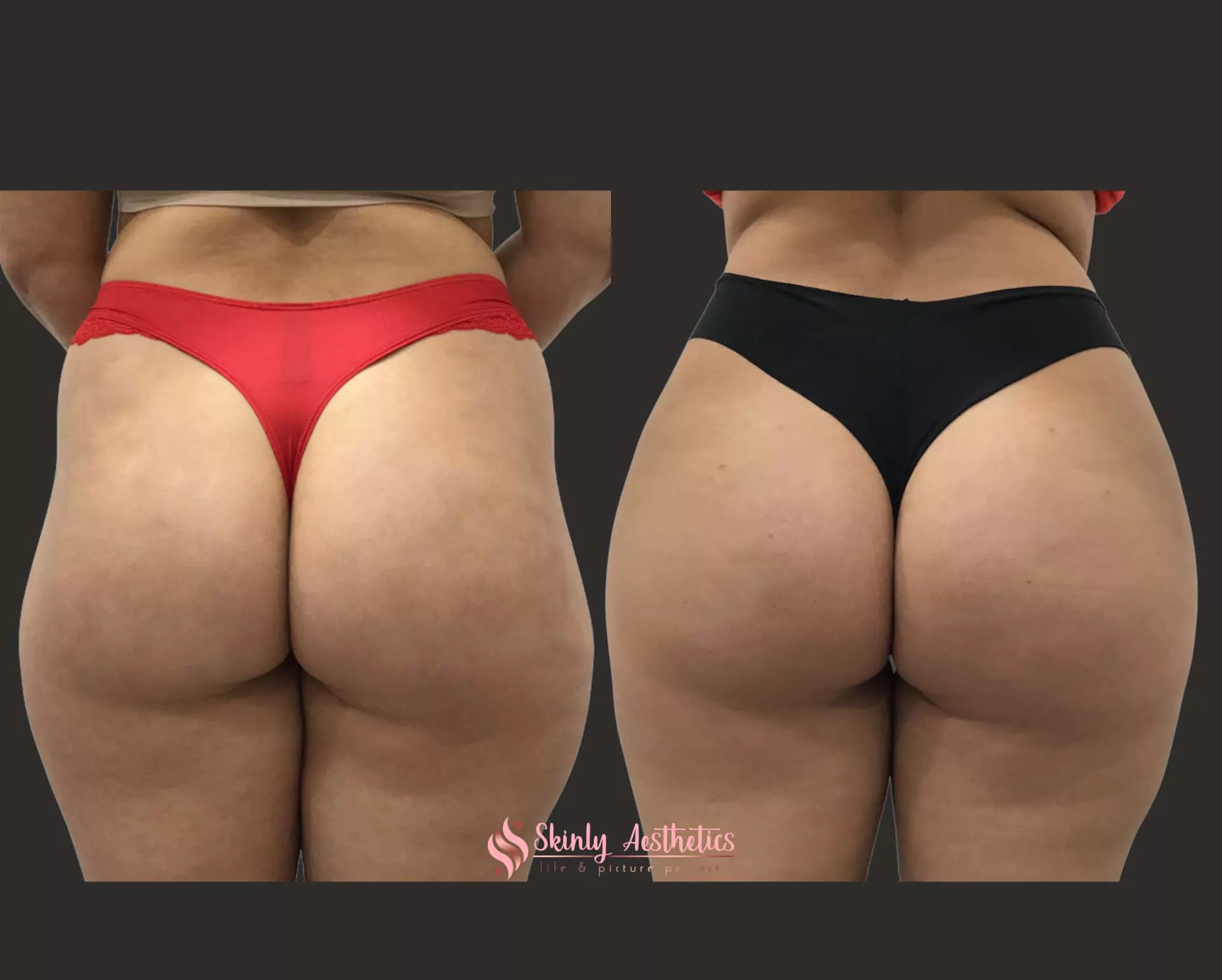 sculptra hip dips