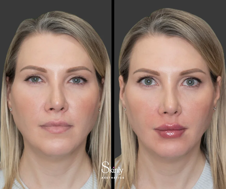 Before and after lip filler for a natural enhancement.