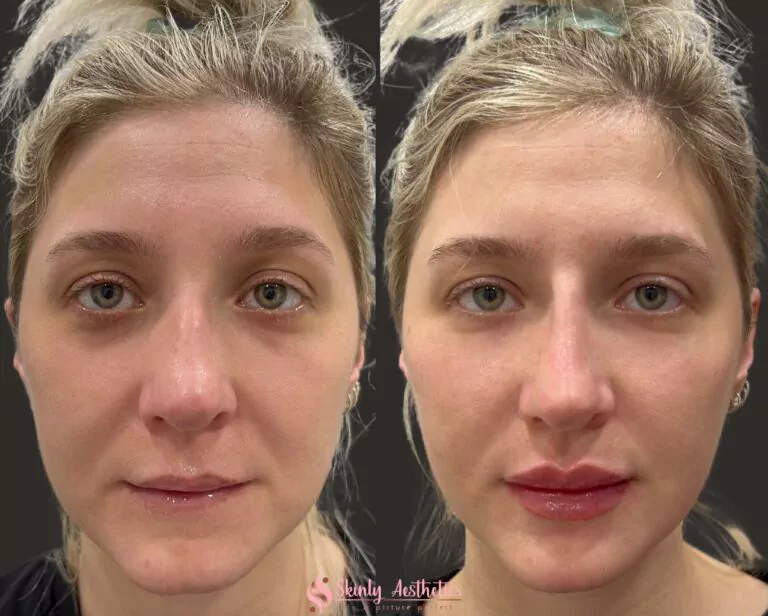correction of deep under eye circles and cheek augmentation with Juvederm fille