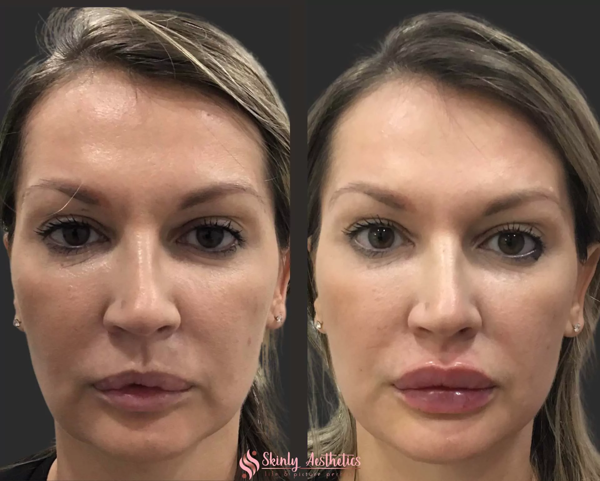 Russian style lip filler augmentation