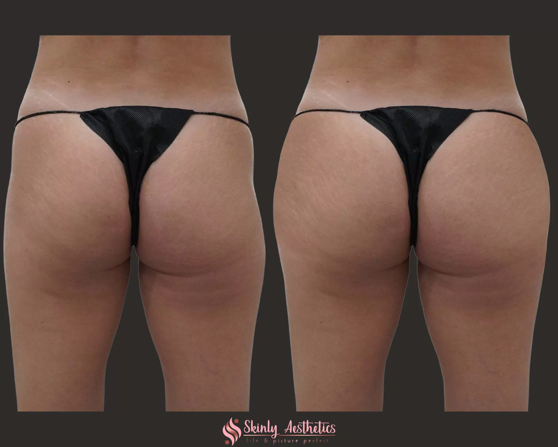hip dip fillers