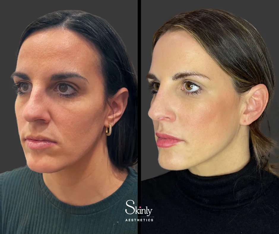 45-degree view before and after cheek injections, showing added volume.