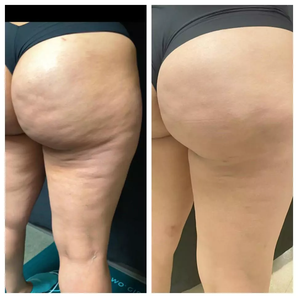 before and after results on buttocks and thighs using QWO treatment Before and after results following Aveli cellulite treatment