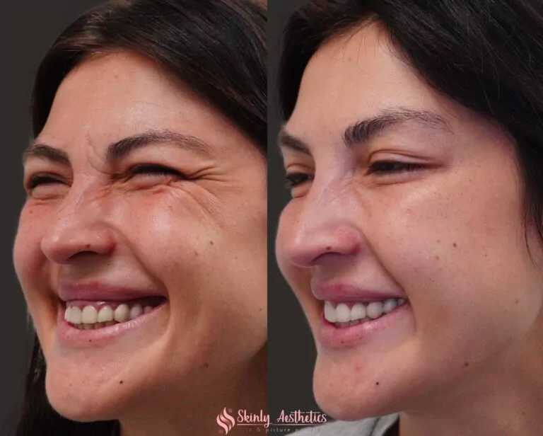 botox procedure crows feet