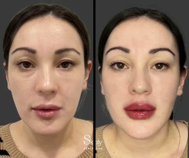 Before and after Russian lip technique with filler, showing vertically enhanced lips.