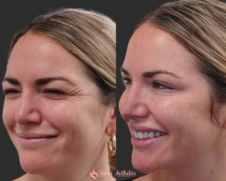 crows feet botox injection