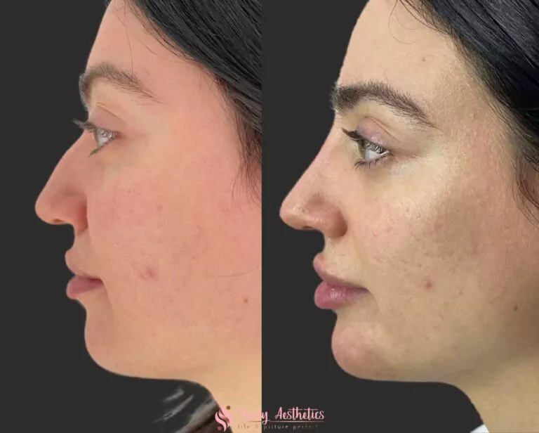 liquid rhinoplasty with Restylane filler