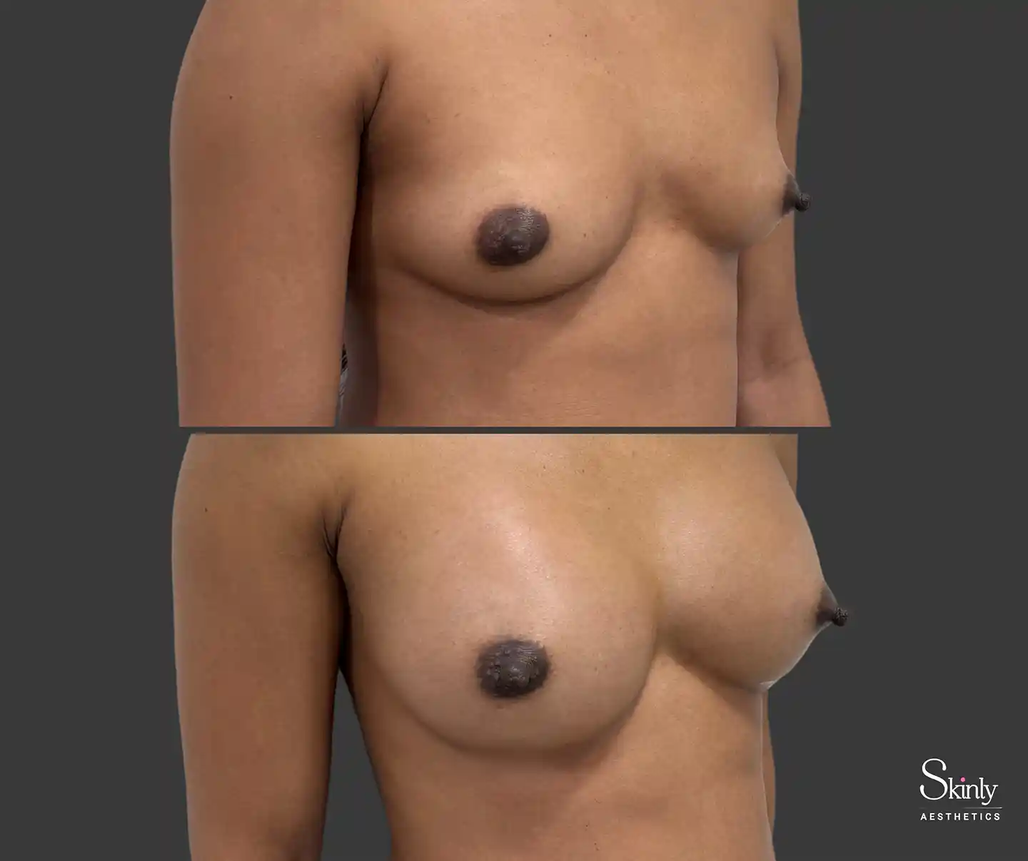 Side profile breast lift results correcting sagging