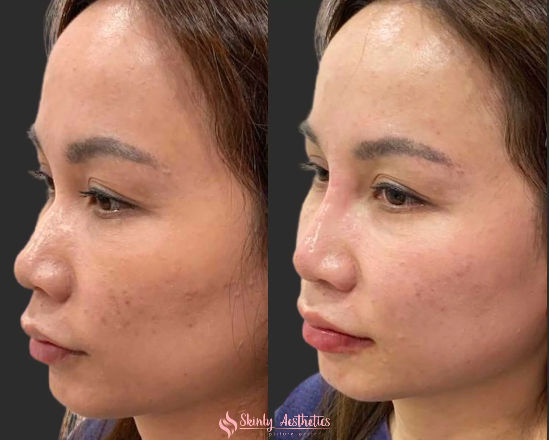 liquid rhinoplasty to augment the nose bridge