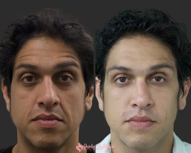 under eye dark circles treated with Juvederm dermal filler