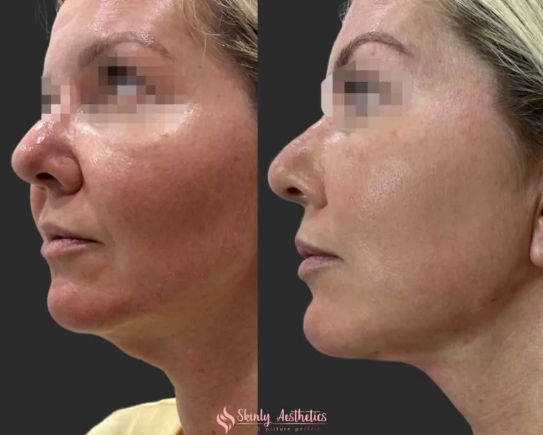 PDO thread neck lift