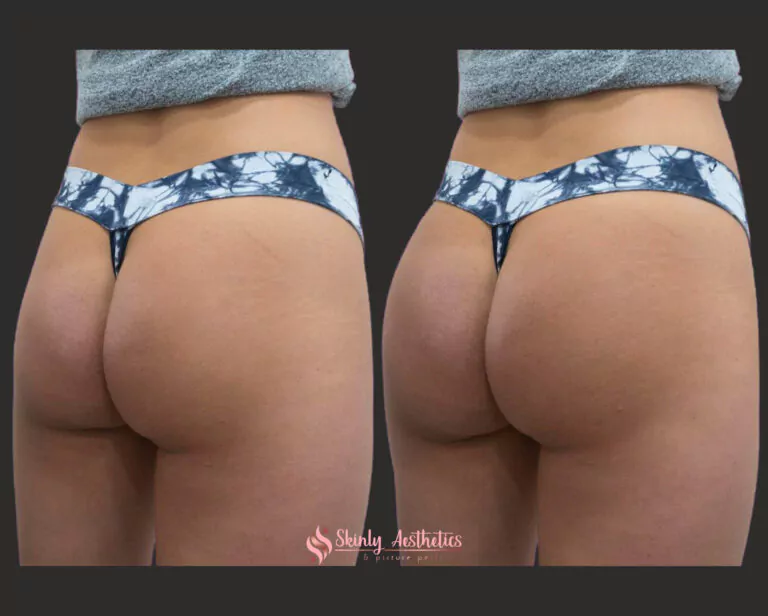 sculptra before and after