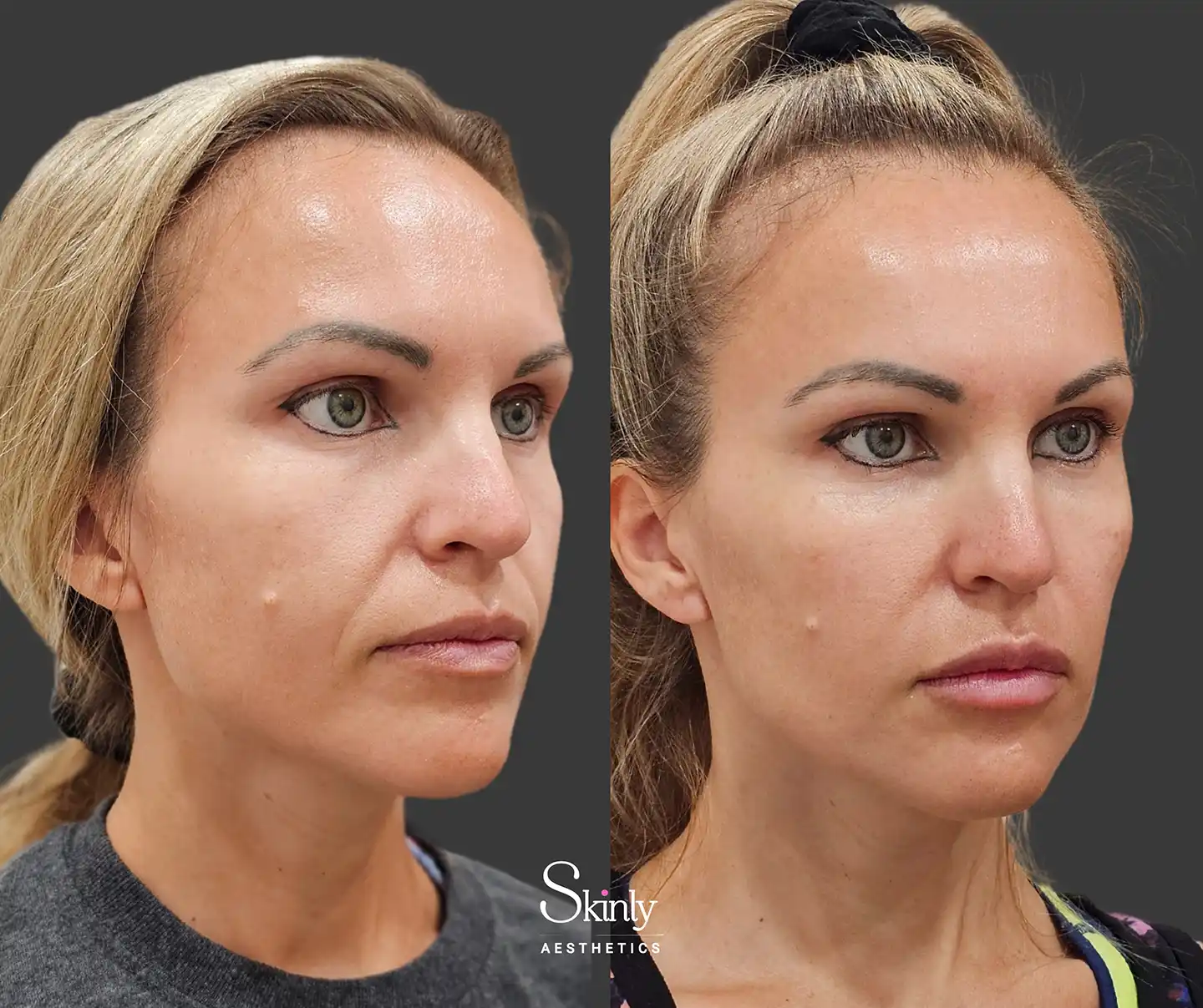 Side view of cheeks and nasolabial folds showing volume restoration from liquid facelift procedure