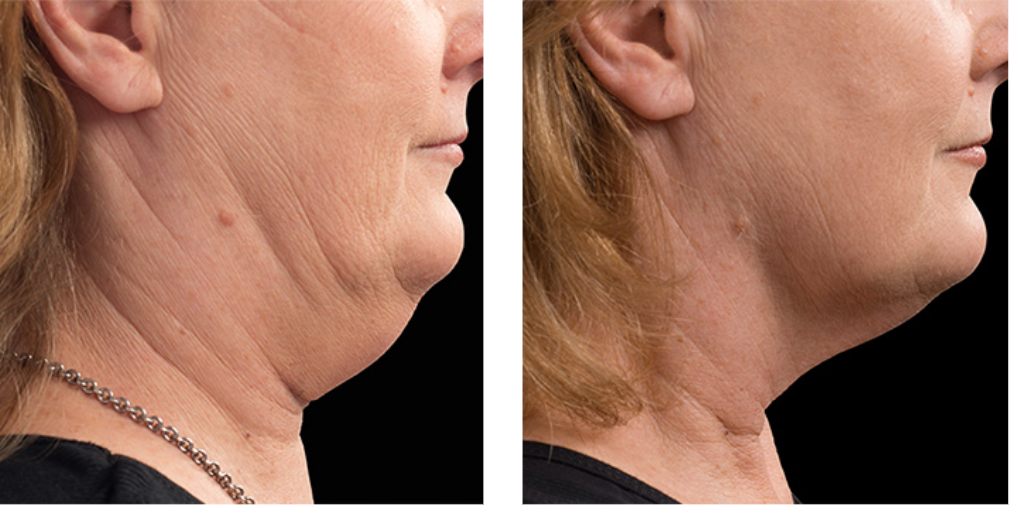 CoolSculpting treatment New York