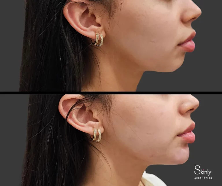 Before and after chin filler showing improved facial harmony.