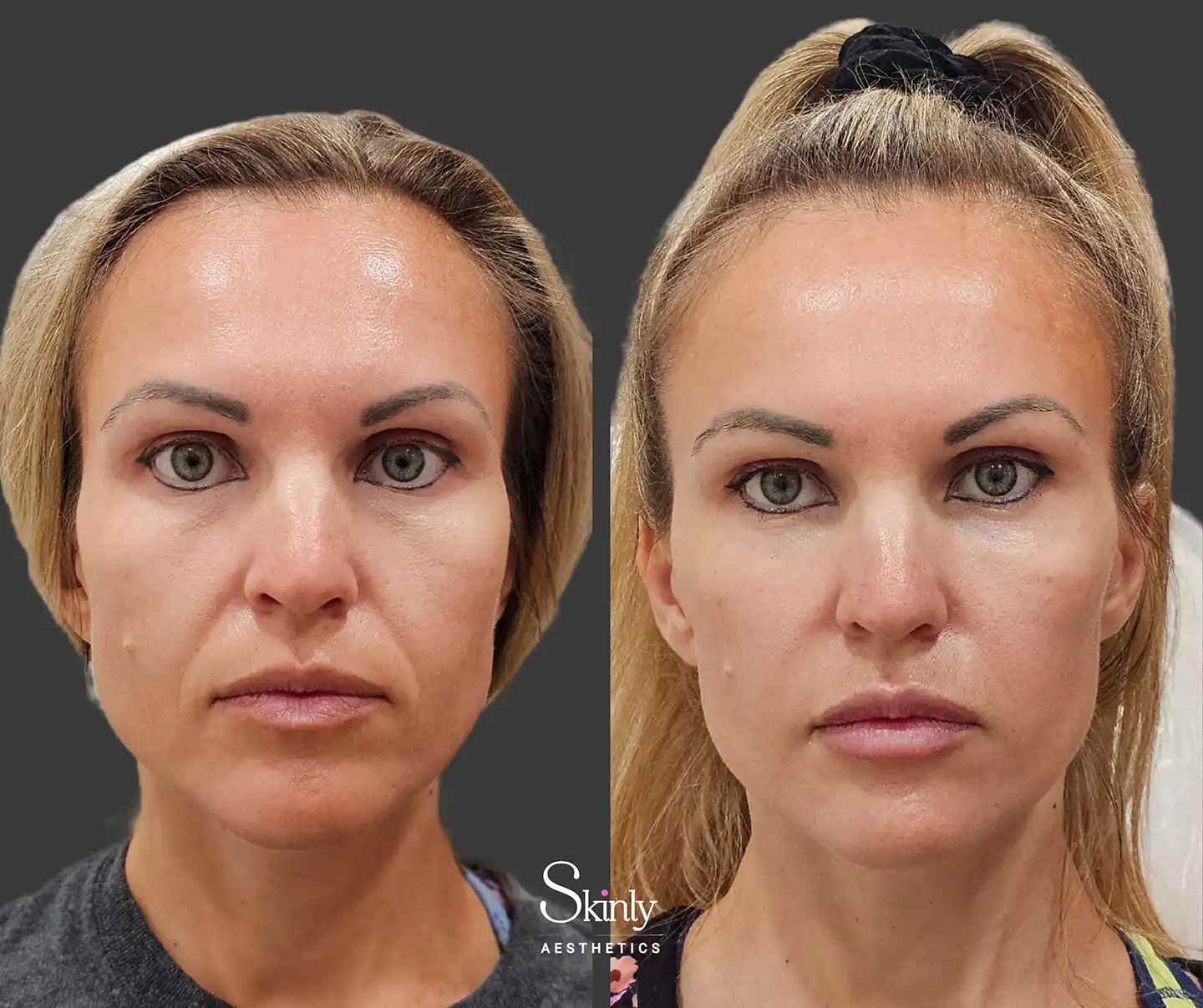 Front view showcasing restored facial fullness and reduction in sagging after liquid facelift