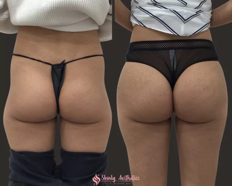 sculptra filler hip dips correction
