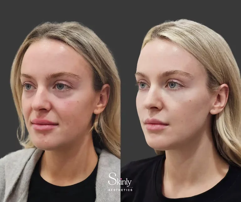 Liquid Facelift results highlighting enhanced facial definition and contours at a 45 degree angle