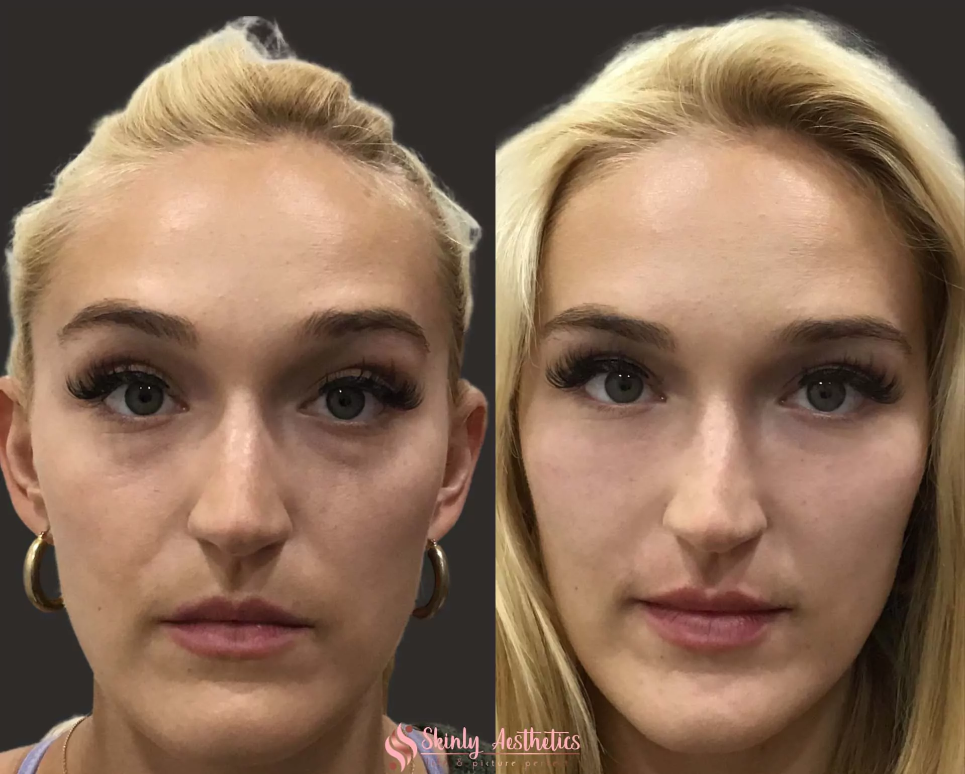 under eye dark circles treated with Restylane