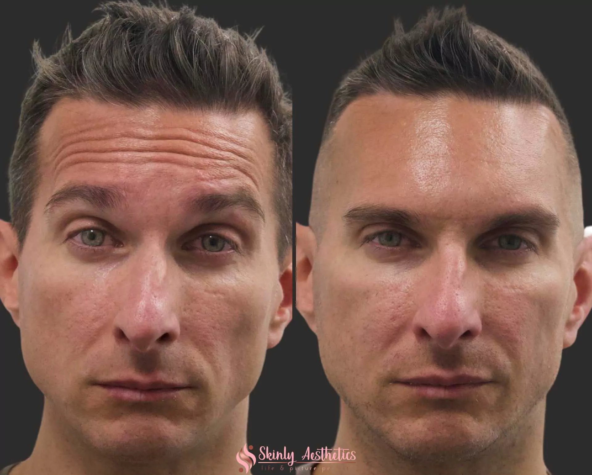 Botox forehead wrinkles male