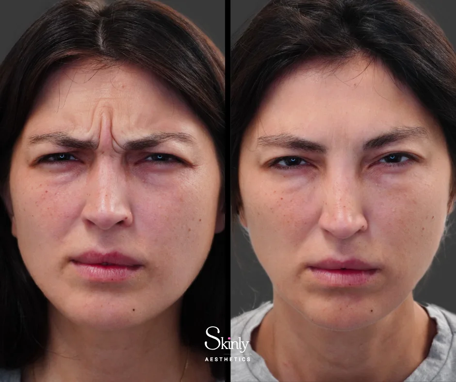 Before and after Botox for 11s glabellar frown lines between the eyebrows in NYC